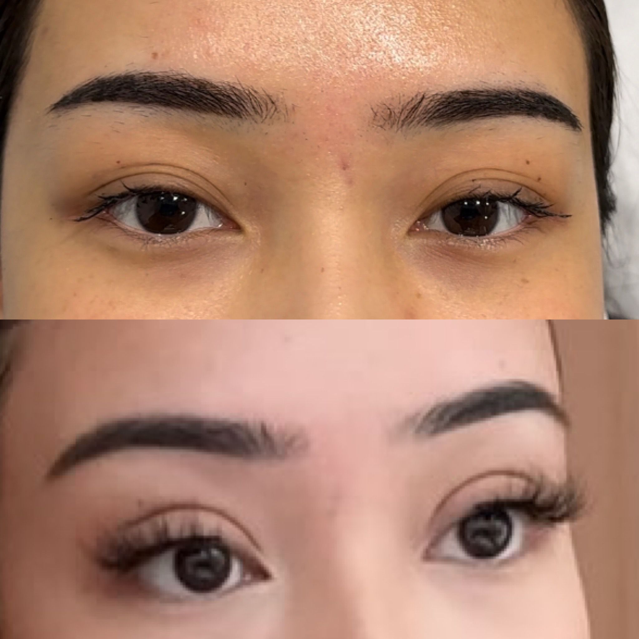 Before and after non-surgical blepharoplasty result showing lifted eye area