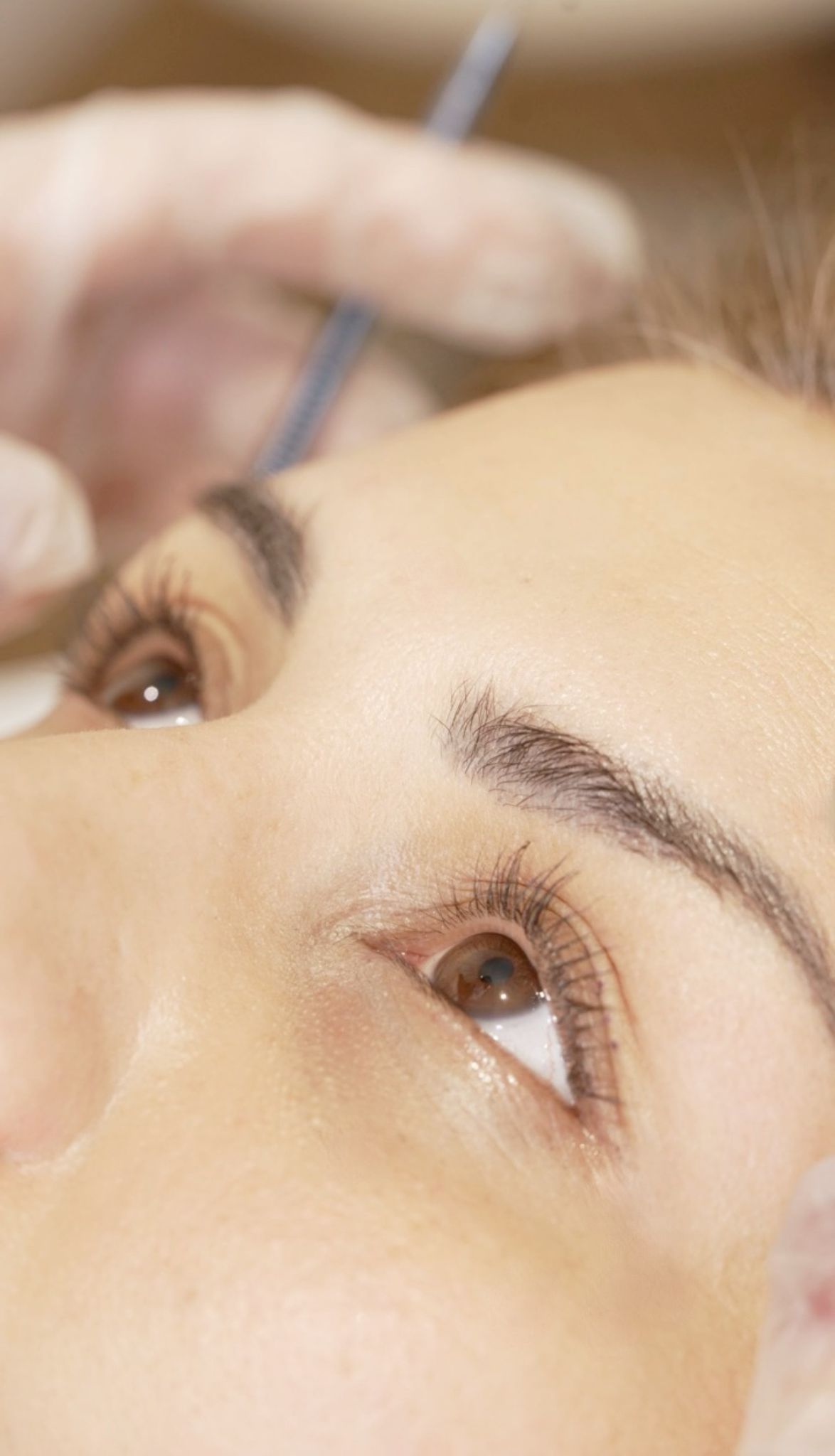 Facial contouring result after aesthetic treatment