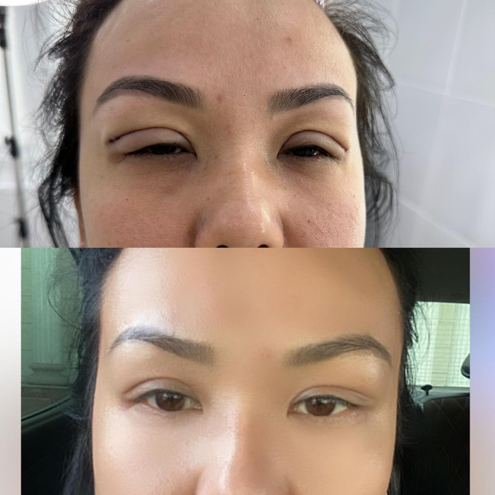 Natural lip augmentation result